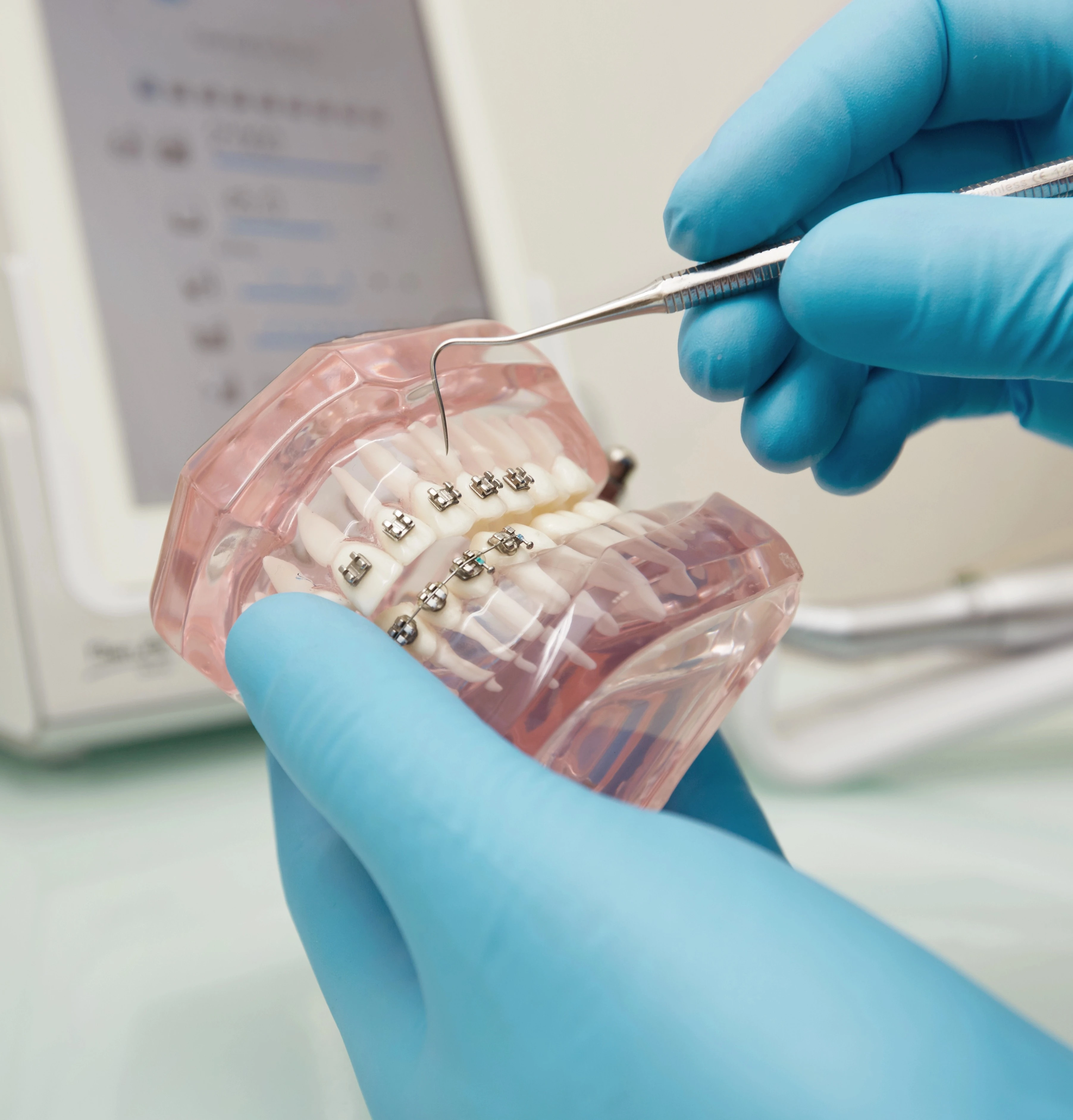 Ceramic Braces